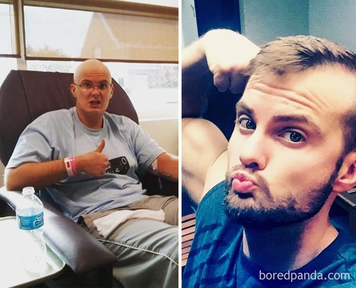 Снимки „преди и след” на хора, които са победили рака