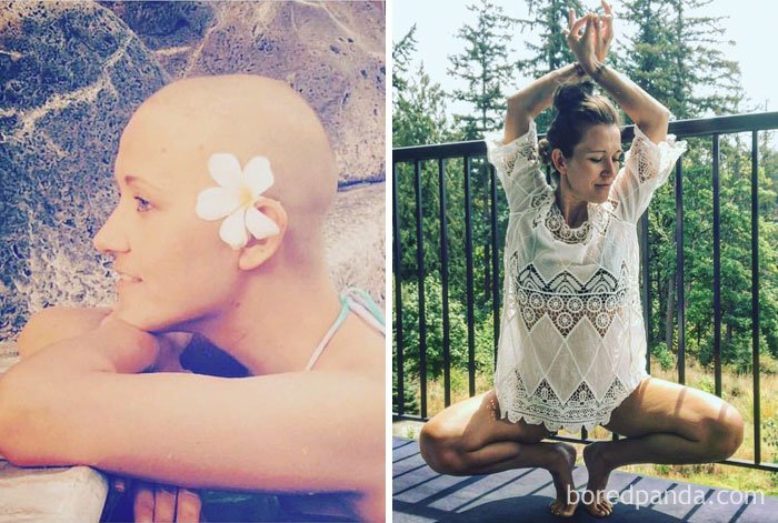 Снимки „преди и след” на хора, които са победили рака